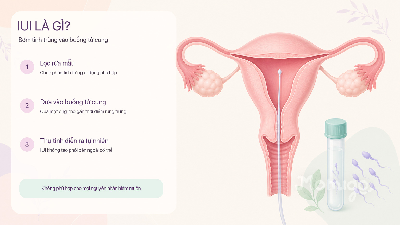 IUI đưa mẫu đã lọc rửa vào buồng tử cung gần thời điểm rụng trứng