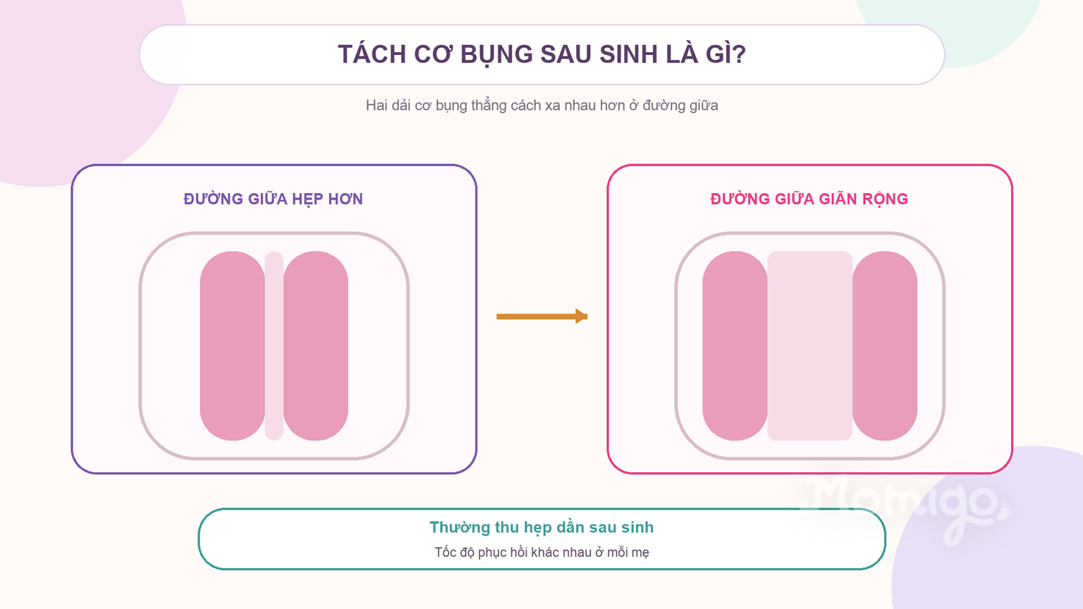 Tách cơ bụng hình thành khi đường giữa hai dải cơ bụng giãn rộng